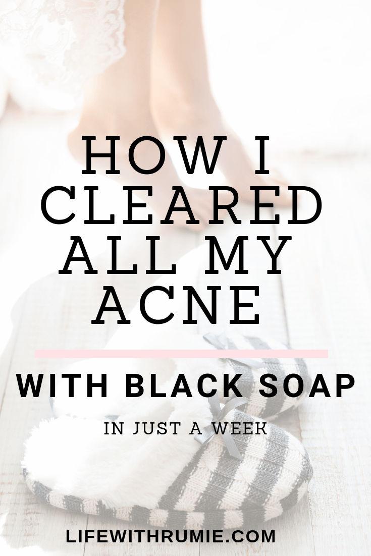 How I cleared my acne using black soap